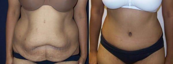 Abdominoplasty