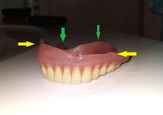 Crap denture work, not symmetrical, total lousy fit, massive sores, total agony, $7000 wasted