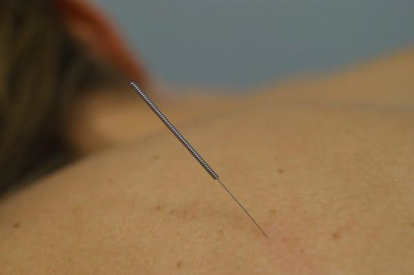 A needle inserted at the point called SI-11 (Tian Zong), used to treat shoulder pain, asthma and difficult lactation.