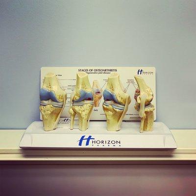 Stages of Osteoarthritis model