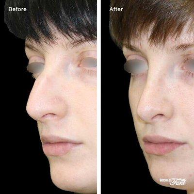 Rhinoplasty