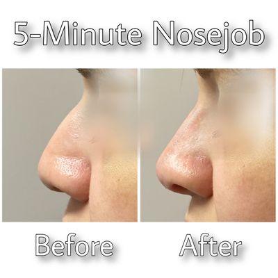 Nonsurgical nose job