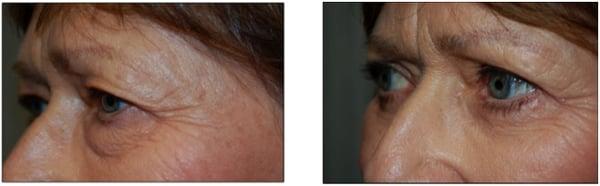 upper and lower eyelid blepharoplasty