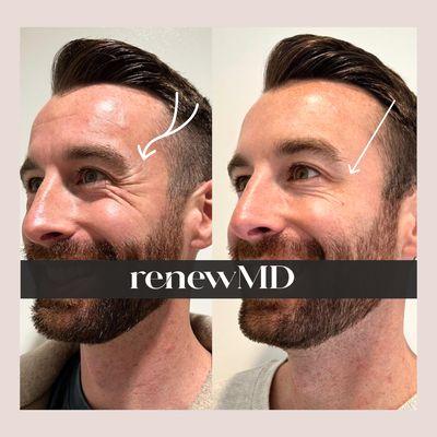 RenewMD