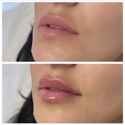 Natural lip filler