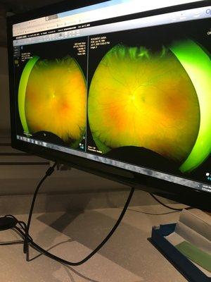 Love Optimap!!! No dilation!