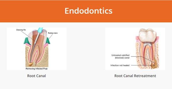 Endodontics in Orange County