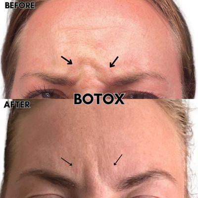 Botox