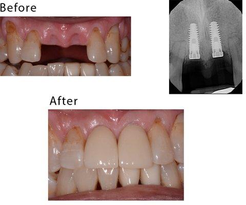 This patient lost his teeth because of periodontal disease. They were restored with implant-supported crowns.