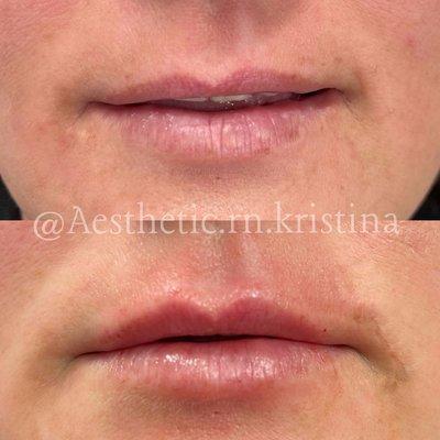 Lip enhancement using Juvederm Volbella (Kristina Russo, RN)