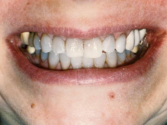 Enhanced, lightened smile through bleaching.