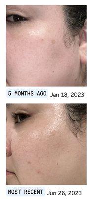 Minus the hormonal new acne my dark spots and tone and texture have improved so much!