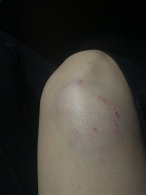 Picture of my knee , night of on 4-9-23 . Tackled and assaulted and bit !