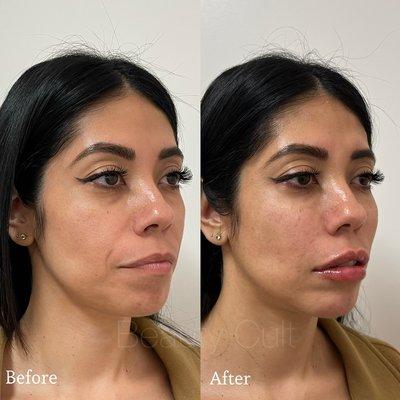 Full face harmonization (Undereye, cheeks, laugh lines, lips, and chin filler)