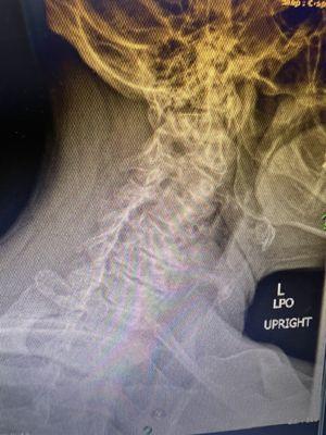 Neck X-ray to assess whiplash after car accident