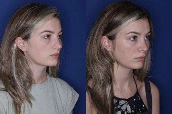 This patient is one month post cosmetic rhinoplasty. She prioritized natural results, facial balance, and harmony.