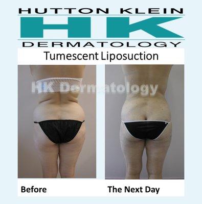 NEXT DAY Tumescent Liposuction results of the hips at HK Dermatology! Are you summer ready??