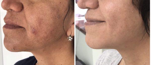 Dark spot removal treatment