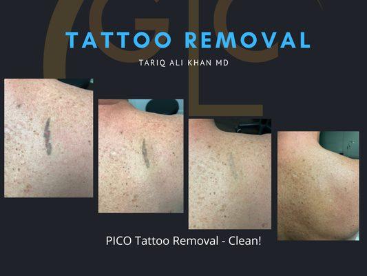 Clean Tattoo Removal - PICO laser