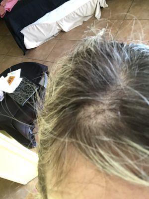 Hair by Karen Landells - balding spot after getting my hair done . The back and neck area also have this . As well as my entire scalp