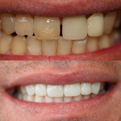 Veneers and crowns