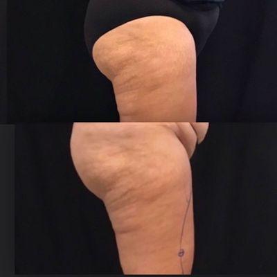 Smart Lipo upper thighs w/ Dr. Caiati, 516-690-7546