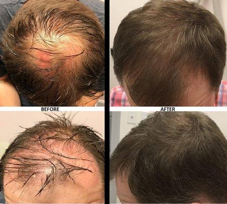 PRP Hair Restoration 3 Treatment Sessions