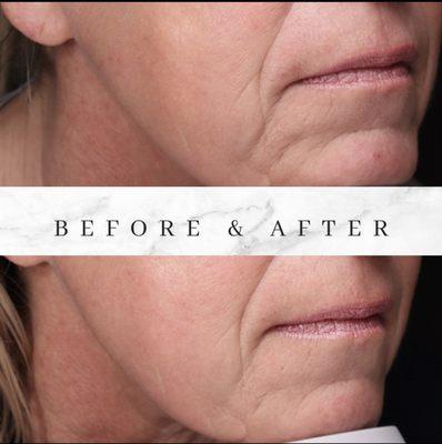 Restore skin texture and diminished fine lines using microneedling!