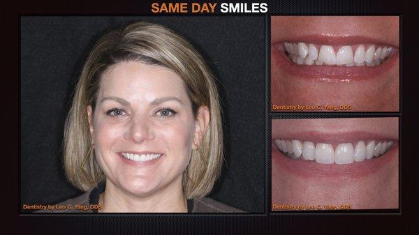 After orthodontic treatment, patient got finishing touches to improve on her smile in the Same Day.