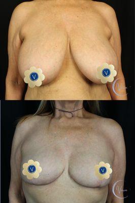 Breast Reduction