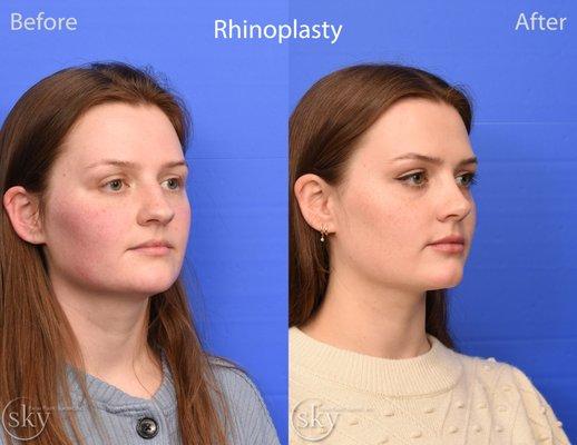 SKY Finesse rhinoplasty