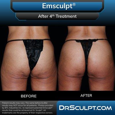 Before and after 4 EmSculpt treatments on glutes.