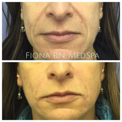 Reduction of nasal labial folds with juvederm and restylane