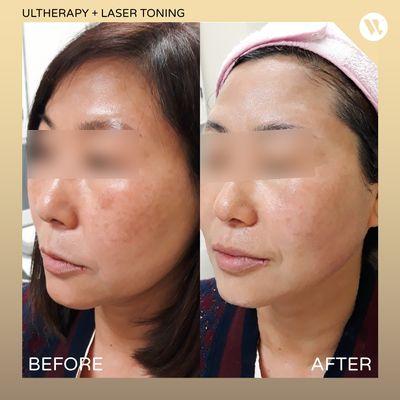 Before and After Ultherapy + Laser Toning at Luz Wave Spa & Aesthetics.