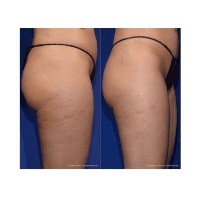 RESONIC Cellulite Treatment in Nashville, TN