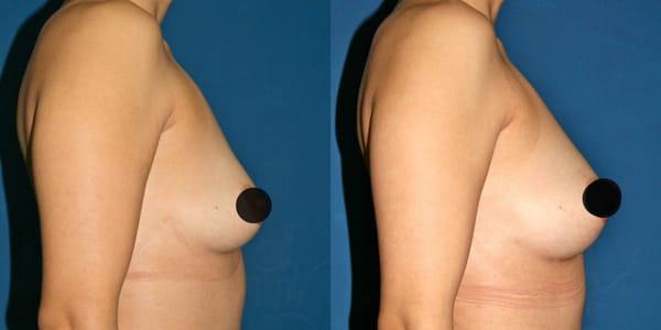 Natural Breast Augmentation with Fat Transfer Before and After. Learn more http://www.drgregpark.com/natural-breast-augmentation