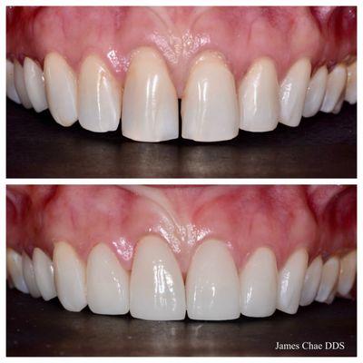 Four Emax crowns. Large interproximal fillings, multiple diastemas and severely worn teeth