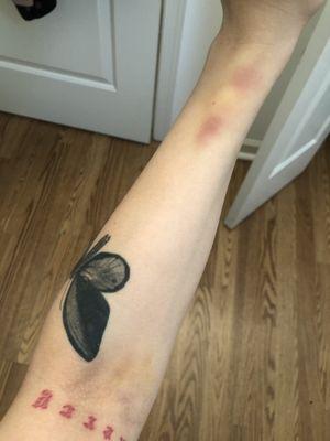 Bruising from blown IV