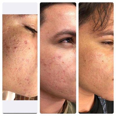 PRP Acne Treatment- 3 Treatment Sessions