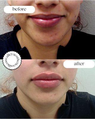 Juvederm Lip Filler before and after done bour wonderful staff!