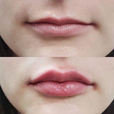 lip filler a few days ago from Laura :)