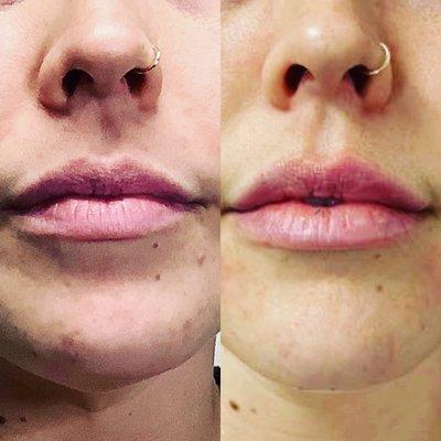 We love lip fillers! Natural outcomes!