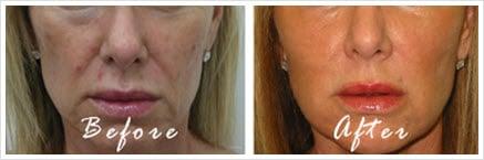 Before and After Radiesse to the Cheeks and Juvederm Ultra Plus to the Mouth Area