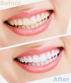 Teeth Whitening