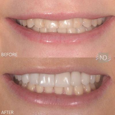 Smile makeover