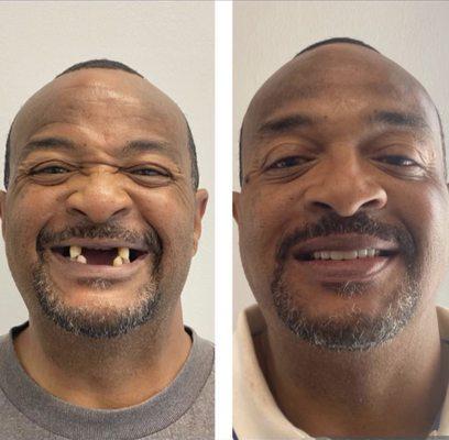 Full mouth reconstruction with implants and denture