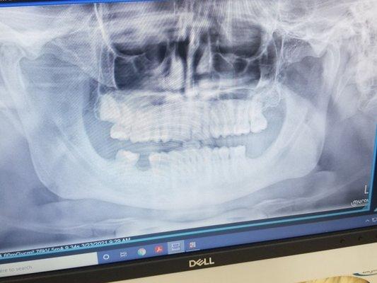 Dr Parham said there was absolutely nothing wrong here.  Hes a quack.  Obvious impacted wisdom tooth is obvious.