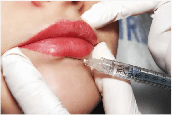 Lip Filler