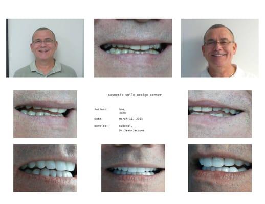 MY SMILE CHANGED UPPER AND LOWER ARCHES IN ONLY 2 DAY VISITS!!!! THANK YOU DR. J.J.EDDERAI