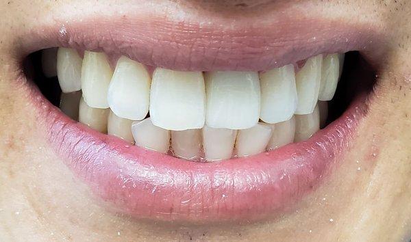 Can you guess which is not the patient's real tooth? (see next photo)